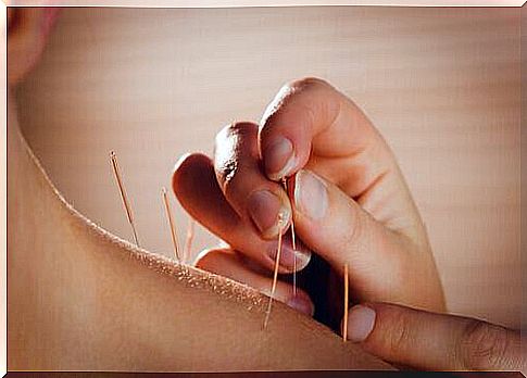Acupuncture - against back pain