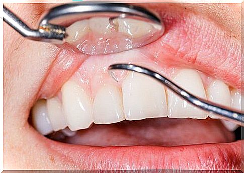 14 reasons for bleeding gums after brushing your teeth