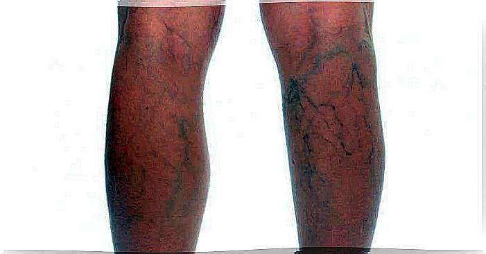 Definition and treatment of phlebitis