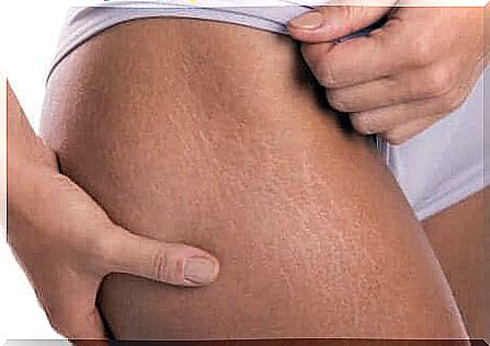 Remedy for stretch marks