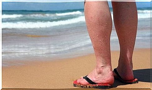Do you have varicose veins?  4 things to avoid in summer