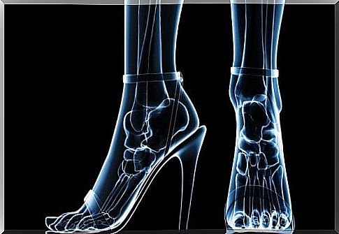 Effects on health from wearing high heel shoes