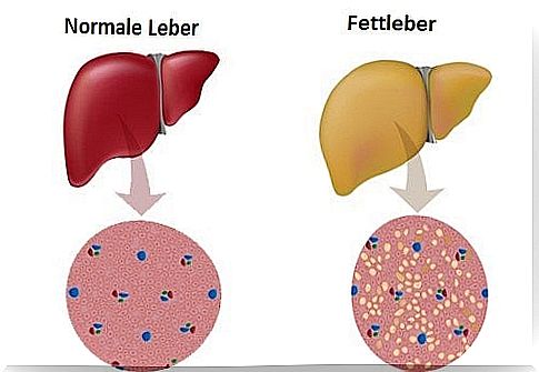 Fatty Liver - What Can I Do?