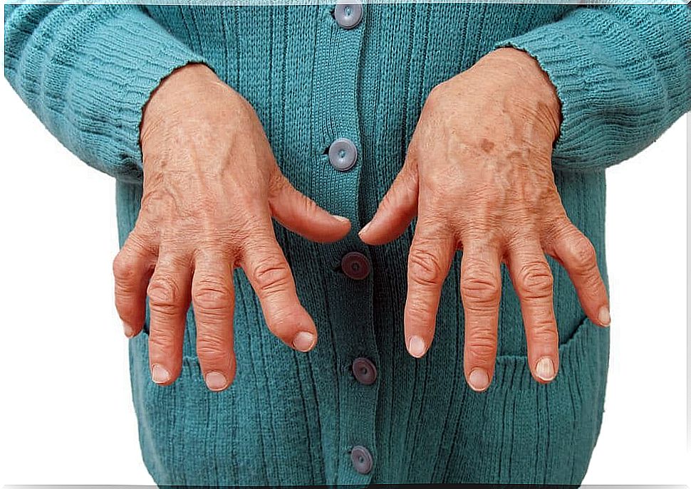 Natural remedies that can help relieve rheumatoid arthritis