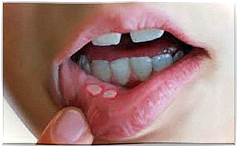 Natural treatment for mouth ulcers