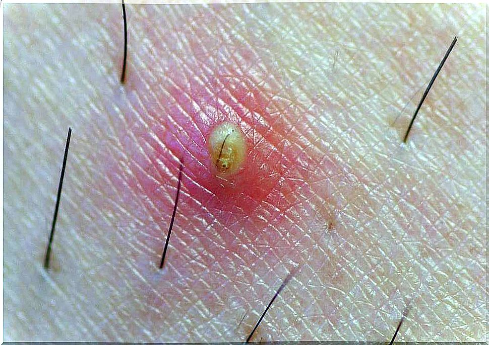 Prevention of ingrown hairs