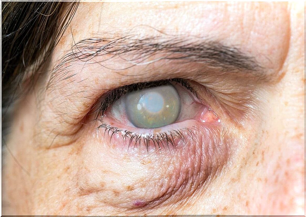 Cataract eye woman vision loss