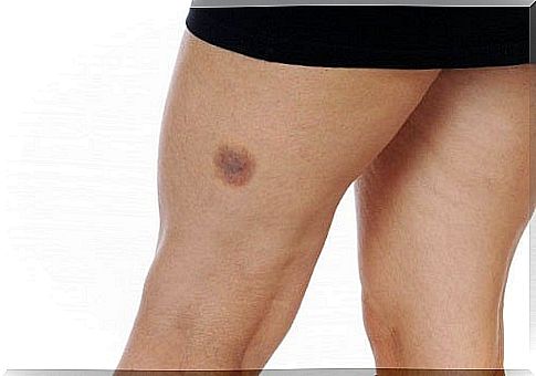 What can you do about bruises?